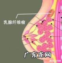 乳腺纤维瘤饮食有什么要求?
