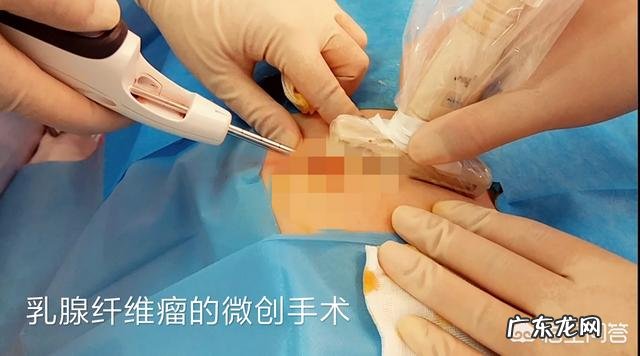 有没有女孩子得过乳腺纤维瘤啊？