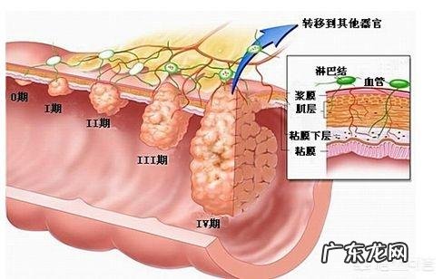 直肠癌晚期都有什么症状？