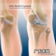 痛风并非悄无声息，排尿出现4种异常，高尿酸已上身，具体指什么