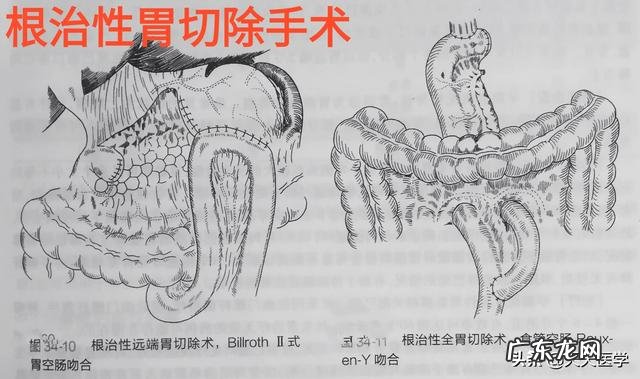 胃癌免疫疗法有效 胃癌免疫zhi疗方法有什么？