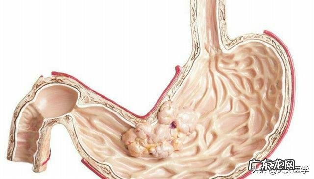 胃癌免疫疗法有效 胃癌免疫zhi疗方法有什么？
