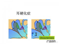 耳石症是怎么得的怎么zhi疗 耳硬化症和耳石症的区别是什么？