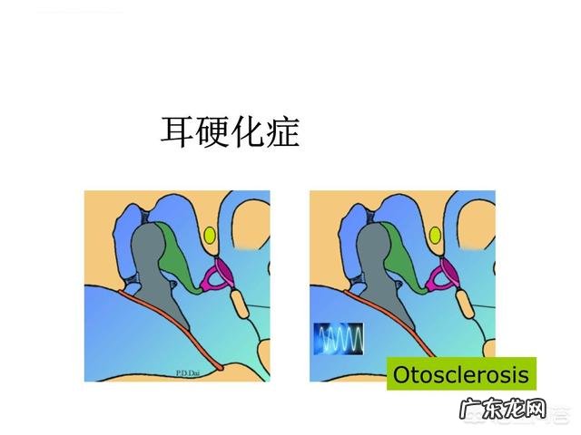 耳石症是怎么得的怎么zhi疗 耳硬化症和耳石症的区别是什么?