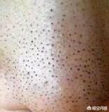 男生的皮肤突然开始变得很油,长了很多闭口,该怎么办