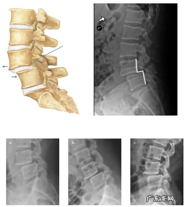 腰椎前滑脱怎么锻炼方法?