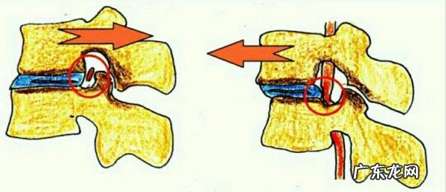 腰椎前滑脱怎么锻炼方法?