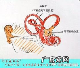 耳石症zhi愈后会复发吗？有什么依据？