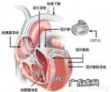 缺血性心肌病安装起搏器的获益能有多大？