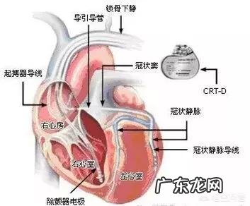 缺血性心肌病安装起搏器的获益能有多大?