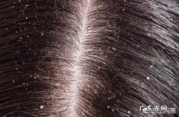 洗完头发不久后头皮屑又会冒出来,这是为什么?