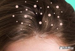 洗完头发不久后头皮屑又会冒出来，这是为什么？