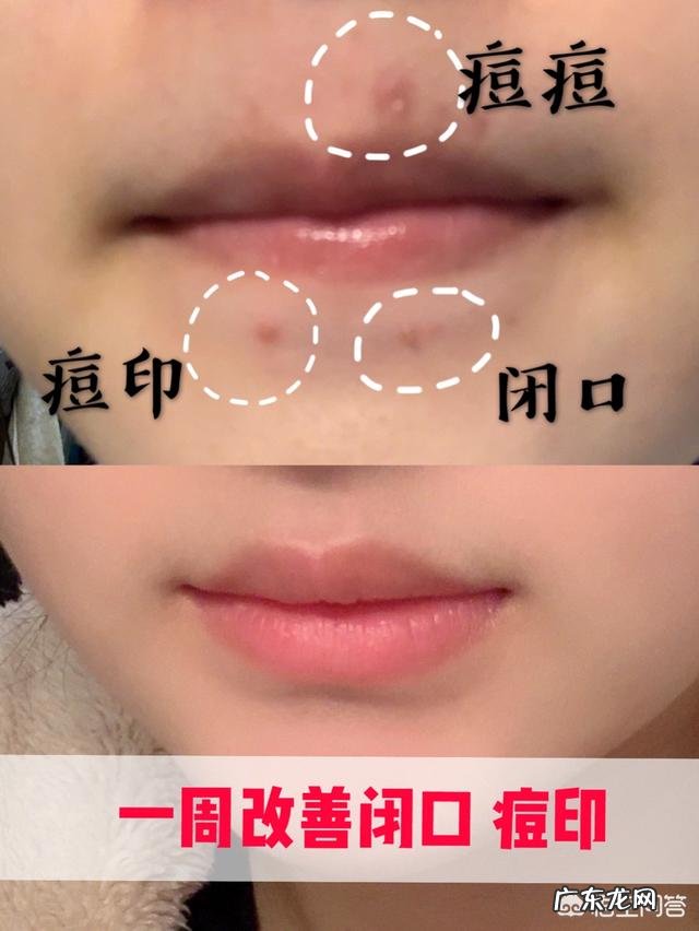 18岁之后还会长痘痘吗?痘痘不只存在于青春期吗?