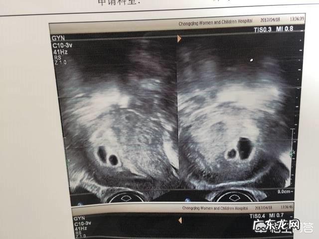 怀双胞胎两个孕囊可以顺产吗