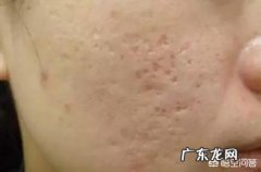 痘坑可以修复吗？如何修复？