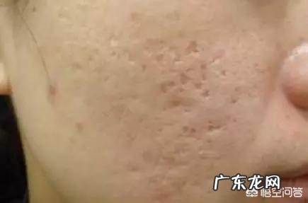 痘坑可以修复吗?如何修复?