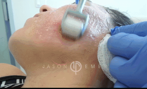 痘坑可以修复吗?如何修复?