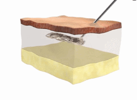 痘坑可以修复吗?如何修复?