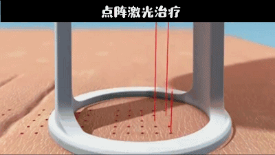 痘坑可以修复吗?如何修复?