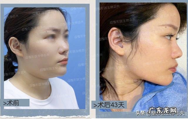 下颌角部位脂肪多怎么消除？