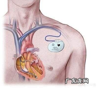 装了起搏器的人要注意什么 装了起搏器以后有什么注意事项