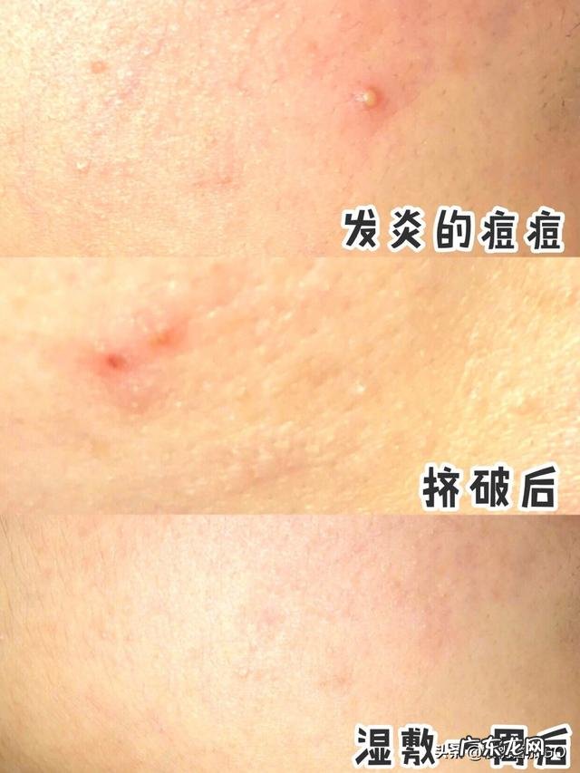 脸上总长白色的痘痘，一碰就很疼，该怎么办？