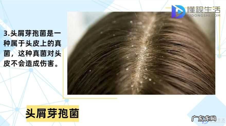 头上痒痒一扣有厚厚的头皮屑？ 头皮屑多是什么原因