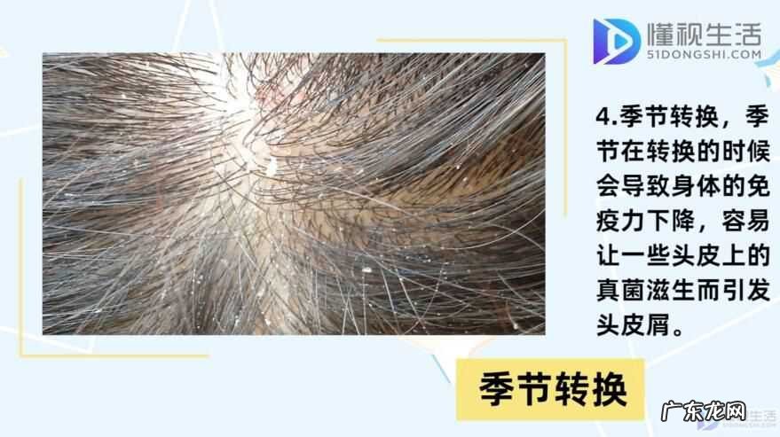 头上痒痒一扣有厚厚的头皮屑？ 头皮屑多是什么原因