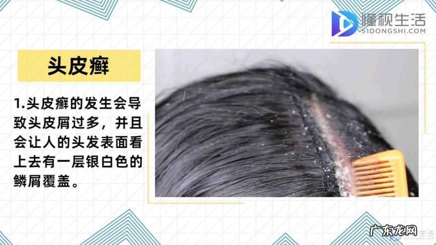 头上痒痒一扣有厚厚的头皮屑？ 头皮屑多是什么原因