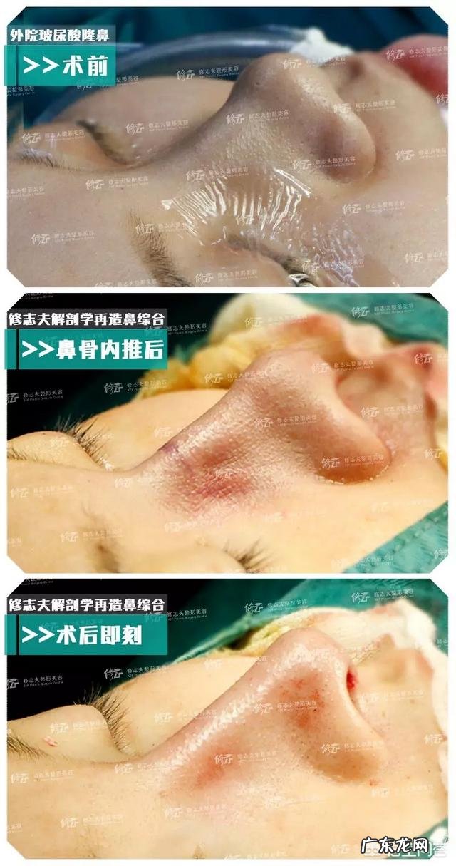 鼻子处皮肤不好，就不适合做鼻综合整形吗？