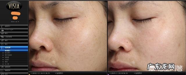 产后脸上长斑该怎么调理？