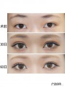 割了双眼皮后多久可以吃鱼？