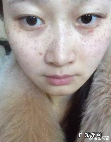 产后长斑祛斑小窍门 祛斑吃维生素c还是e?产后长斑怎么去除呢?