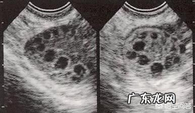 因为多囊怀不上孩子，有成功的吗？该怎么备孕？