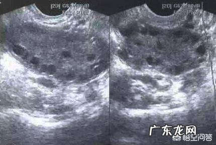 因为多囊怀不上孩子,有成功的吗?该怎么备孕?