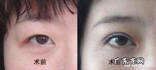 双眼皮拆线后忌嘴多久 双眼皮拆线后还要忌口多久？