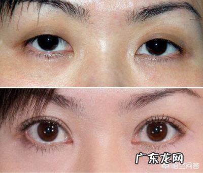 双眼皮拆线后忌嘴多久 双眼皮拆线后还要忌口多久？