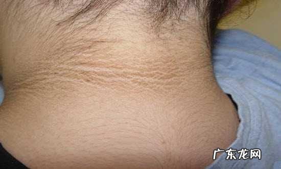 脖子黑怎么也洗不掉是什么情况 脖子黑黑的总洗不掉是怎么回事?