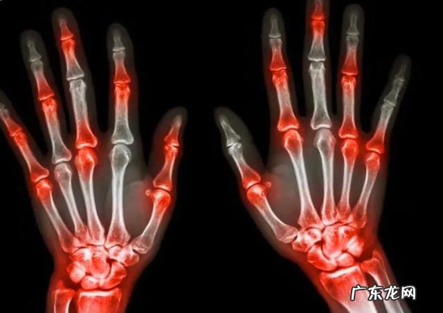 肥胖的人是不是更容易尿酸高