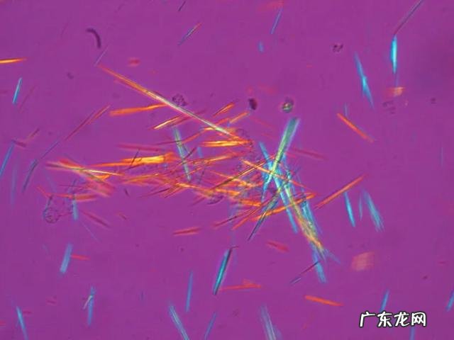 肥胖的人是不是更容易尿酸高