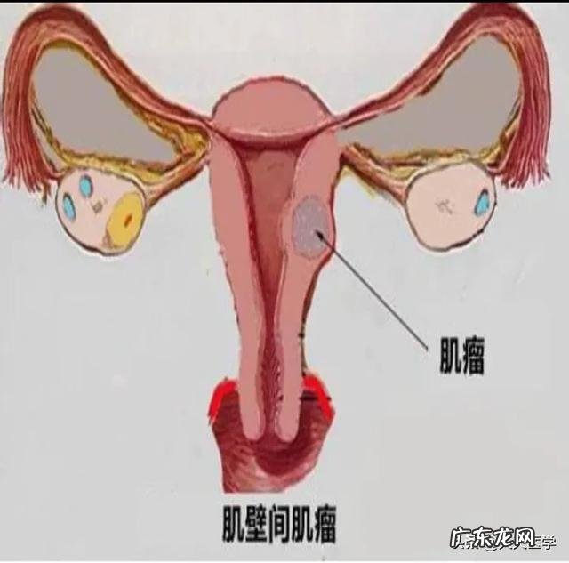 子宫肌瘤手术后多久可以锻练?