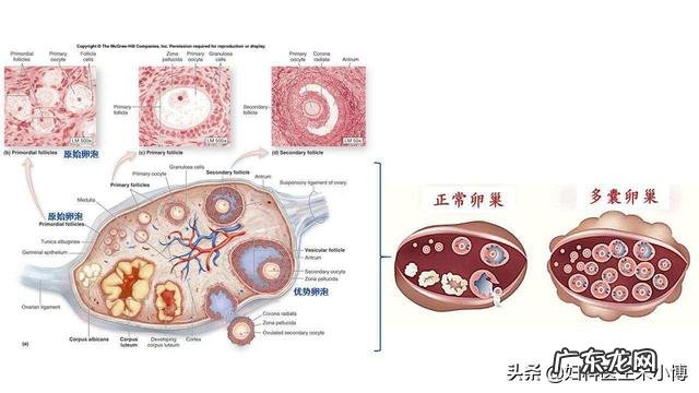 多囊卵巢患者，睾酮偏高，能够怀孕吗？
