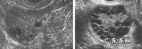 多囊卵巢患者，睾酮偏高，能够怀孕吗？