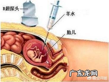 羊水穿刺结果异常必须做引产吗