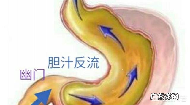 胃食管返流是什么情况如何才能缓解