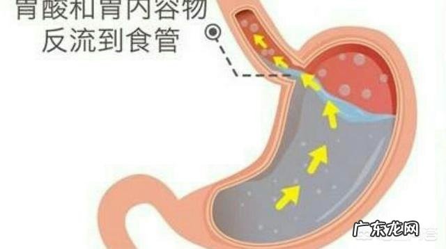 胃食管返流是什么情况如何才能缓解