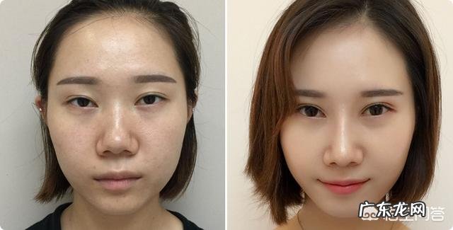 隆鼻的康复期是多长时间啊?