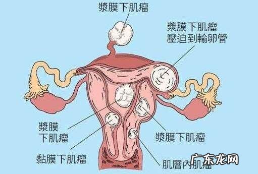 子宫肌瘤患者需要注意哪些忌口?