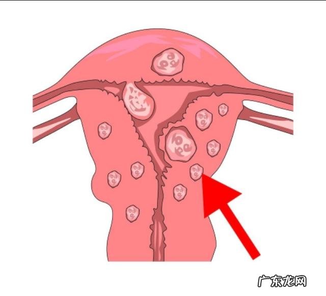 子宫肌瘤患者需要注意哪些忌口?