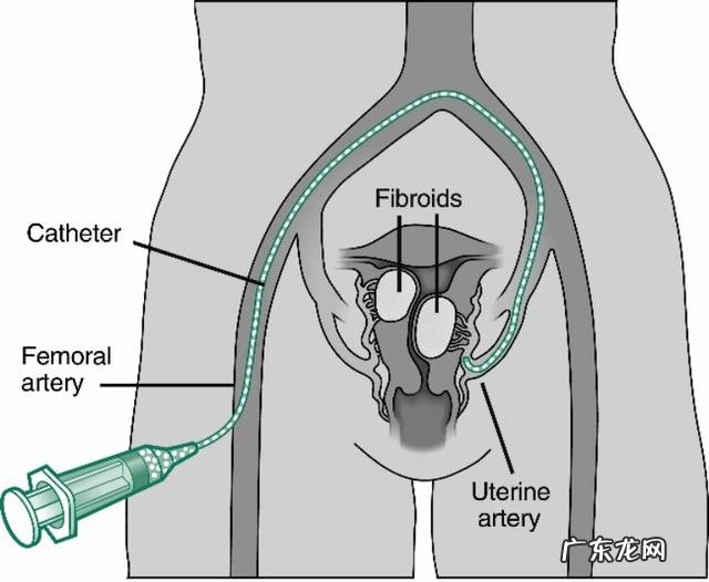 子宫肌瘤患者需要注意哪些忌口?